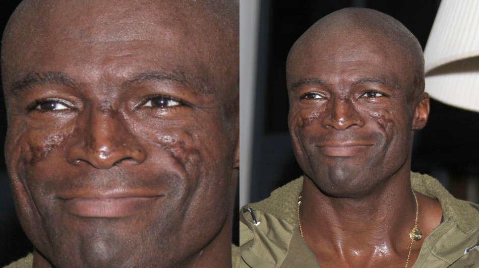 Seals facial scars