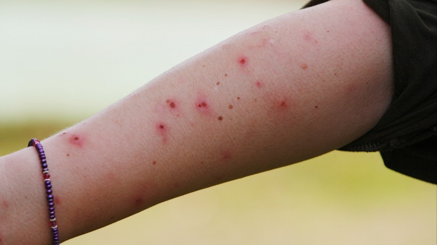 Дачные угрозы: насколько опасны укусы комаров, ос, слепней, змей