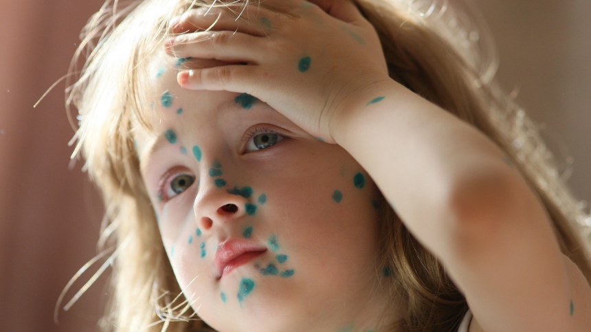 Зарази меня полностью: зачем родители устраивают ветряночные вечеринки для детей